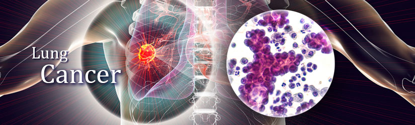 肺癌标志物 肺癌标志物