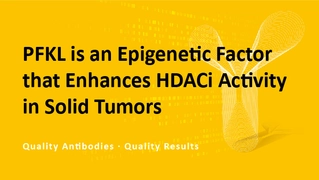 PFKL is an Epigenetic Factor that Enhances HDACi Activity in Solid Tumors PFKL is an Epigenetic Factor that Enhances HDACi Activity in Solid Tumors