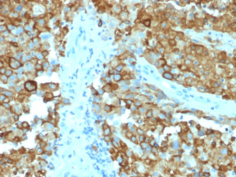 Anti-Melanoma gp100 antibody [PMEL/2038] used in IHC (Paraffin sections) (IHC-P). GTX17773