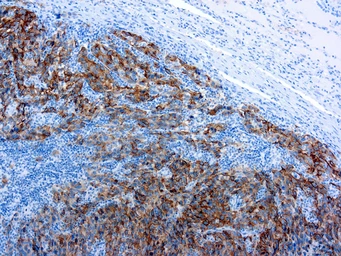 Anti-Melanoma antibody [HMB45] (ready-to-use) used in IHC (Paraffin sections) (IHC-P). GTX20906