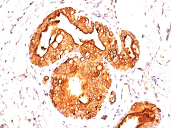 Anti-MUC1 antibody [MUC1/955] used in IHC (Paraffin sections) (IHC-P). GTX34852