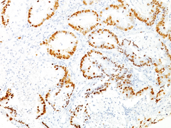 Anti-NKX2.1 antibody [8G7G3/1] used in IHC (Paraffin sections) (IHC-P). GTX34907