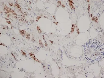 Anti-Progesterone Receptor antibody [1A6] used in IHC (Paraffin sections) (IHC-P). GTX75363