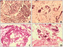 Human Matched Pair Tissue Array - Liver Tumor. GTX20310